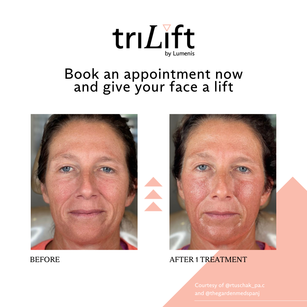 a woman's face before and after TriLift treatment