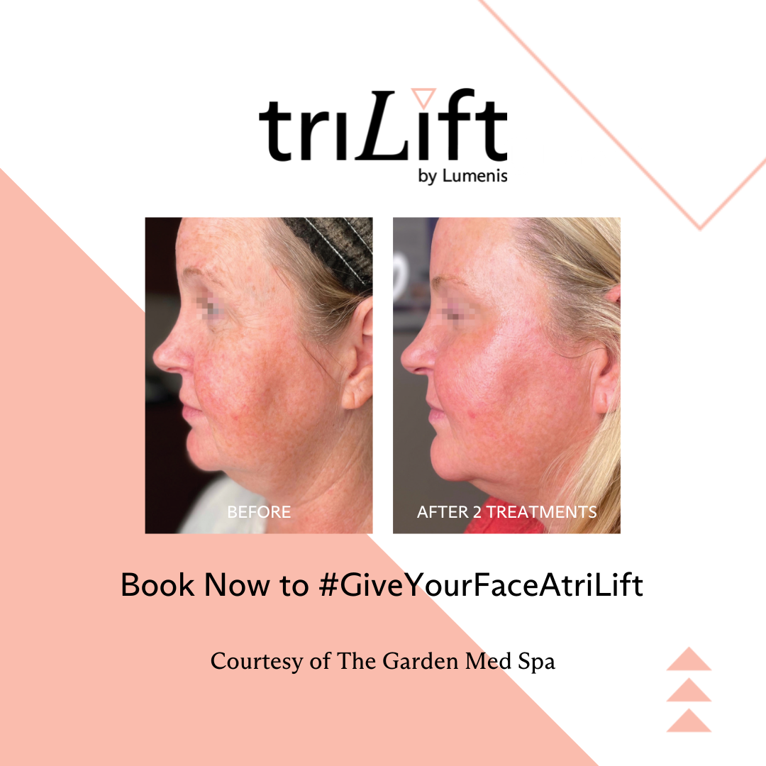 a woman's face before and after TriLift treatment