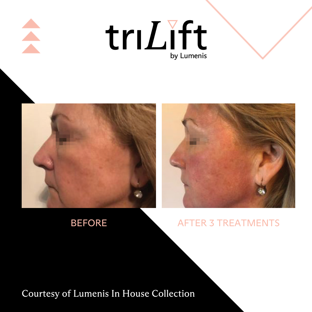 a woman's face before and after TriLift treatment