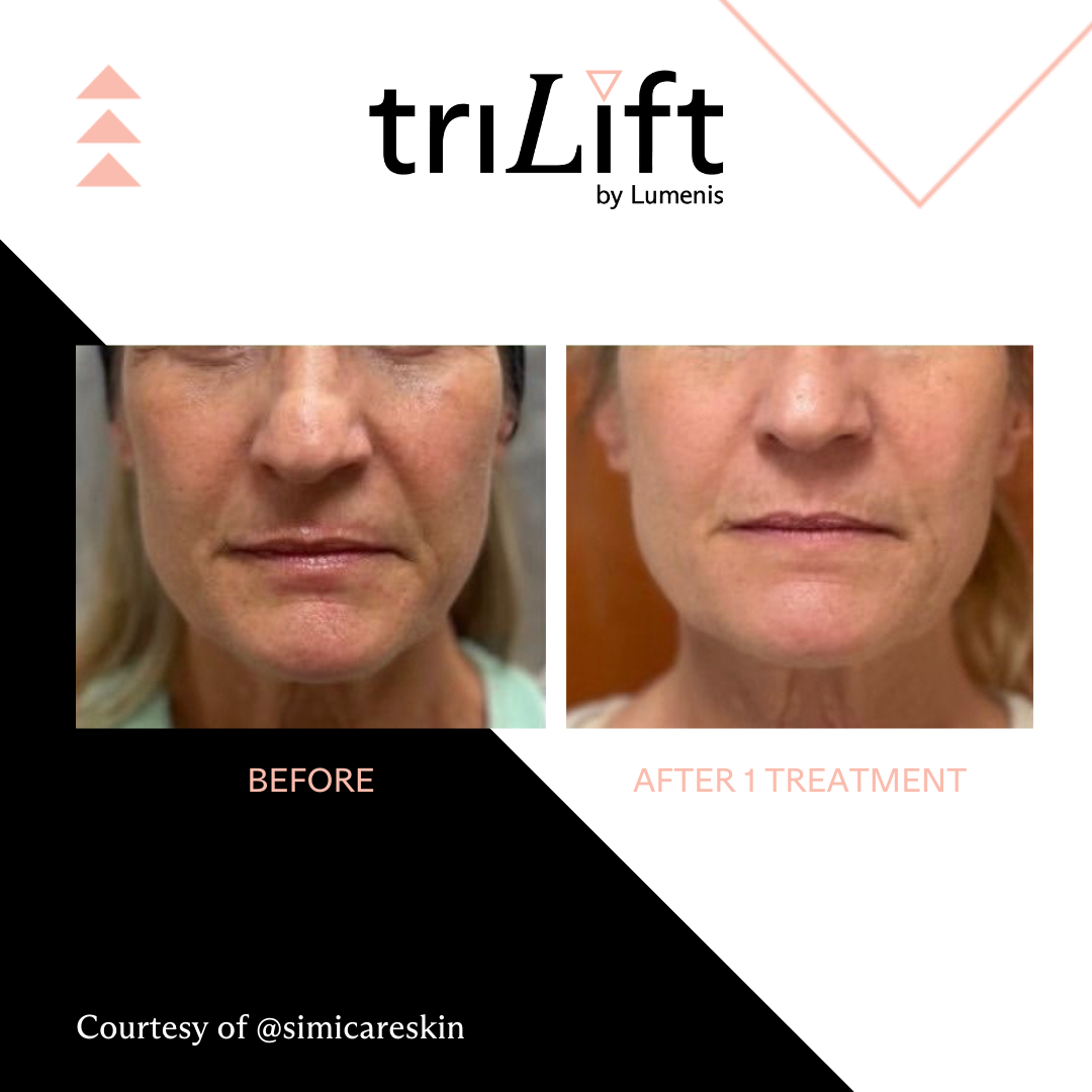 a woman's face before and after TriLift treatment