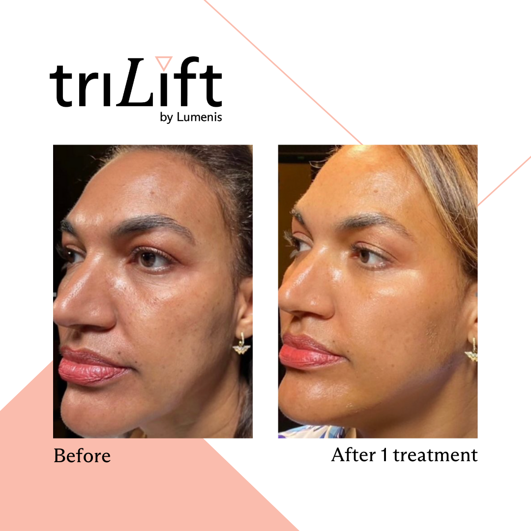 a woman's face before and after TriLift treatment