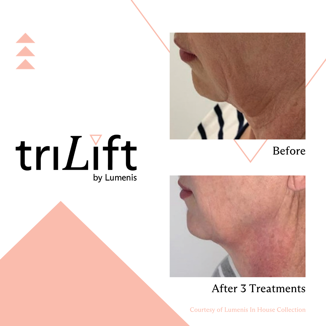 a woman's face before and after TriLift treatment