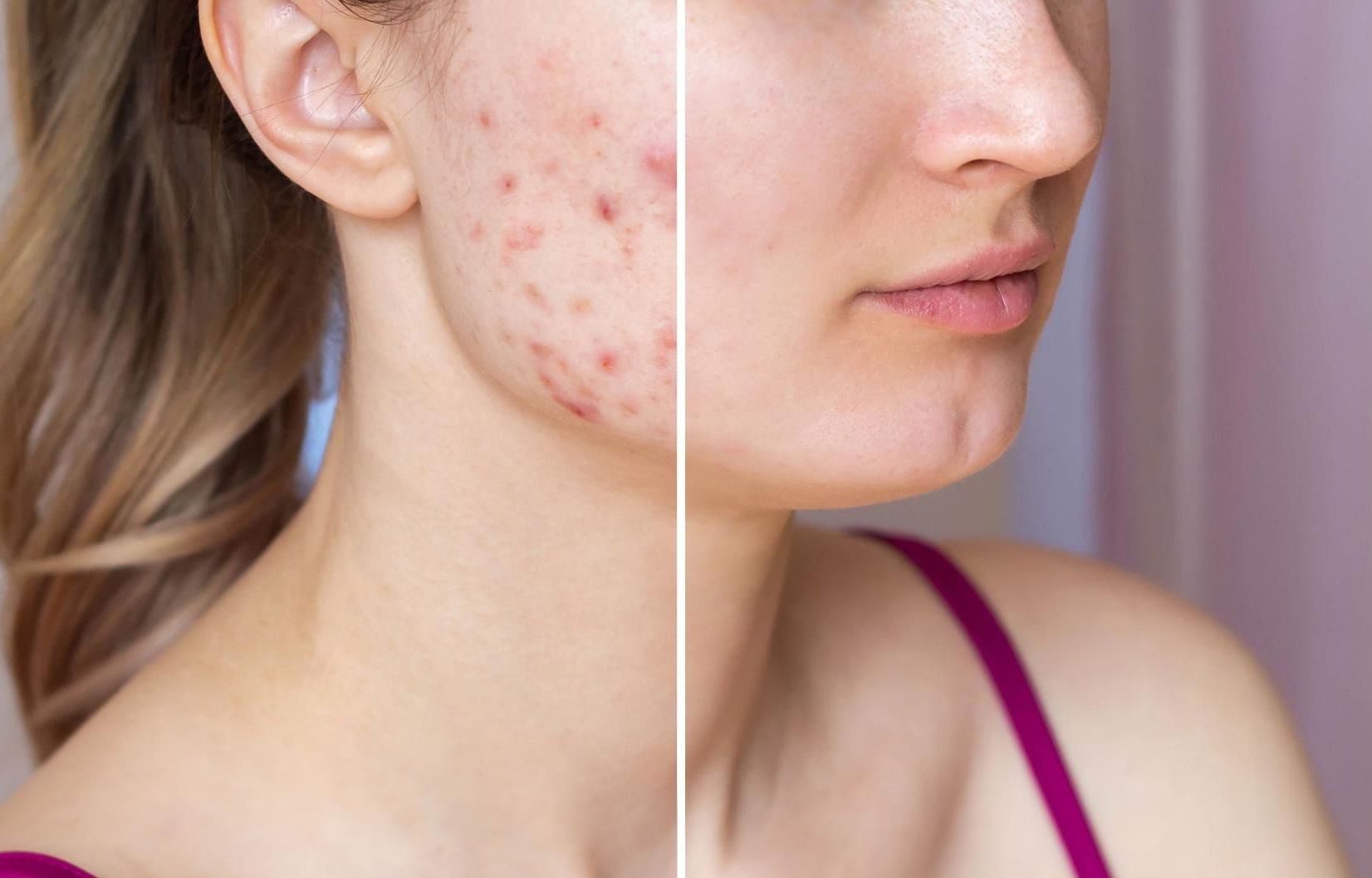 woman's lower face before and after acne facial treatment