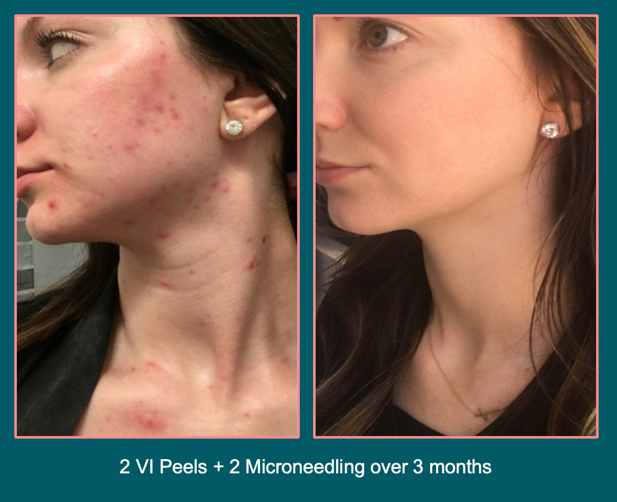woman's face and chest before and after VI Peel chemical peel treatment