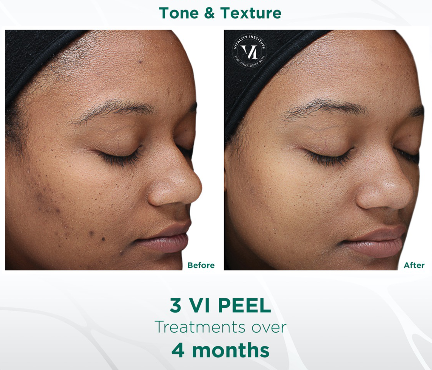 woman's face before and after VI Peel chemical peel treatment