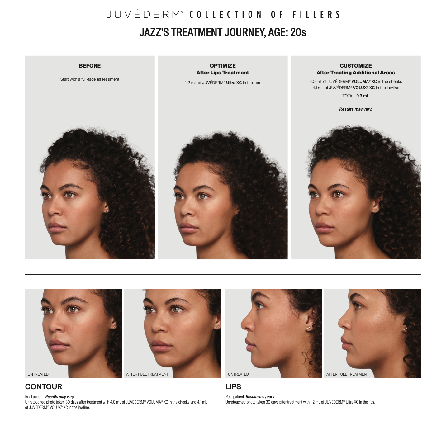 a woman's face before and after Juvederm treatment