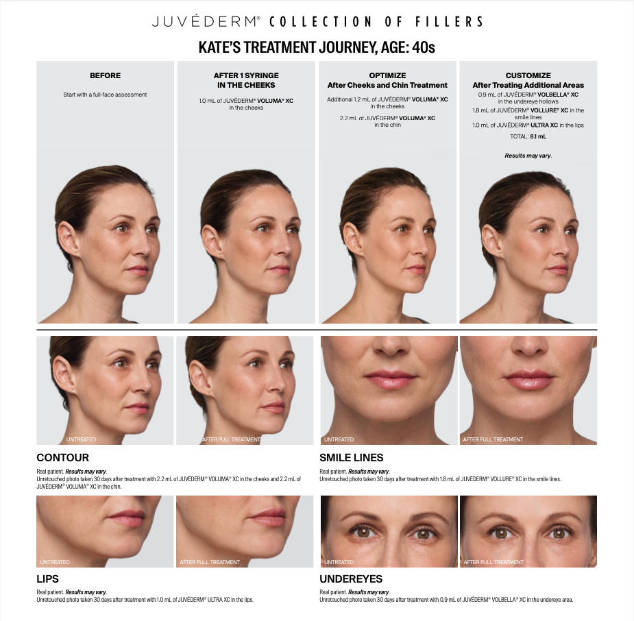 a woman's face before and after Juvederm treatment