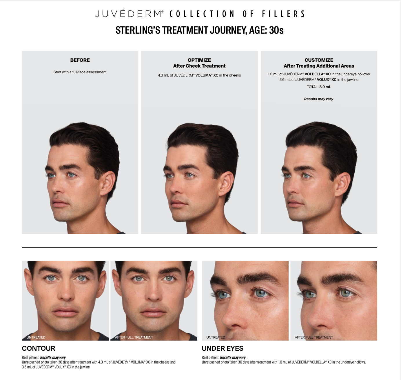 a man's face before and after Juvederm treatment