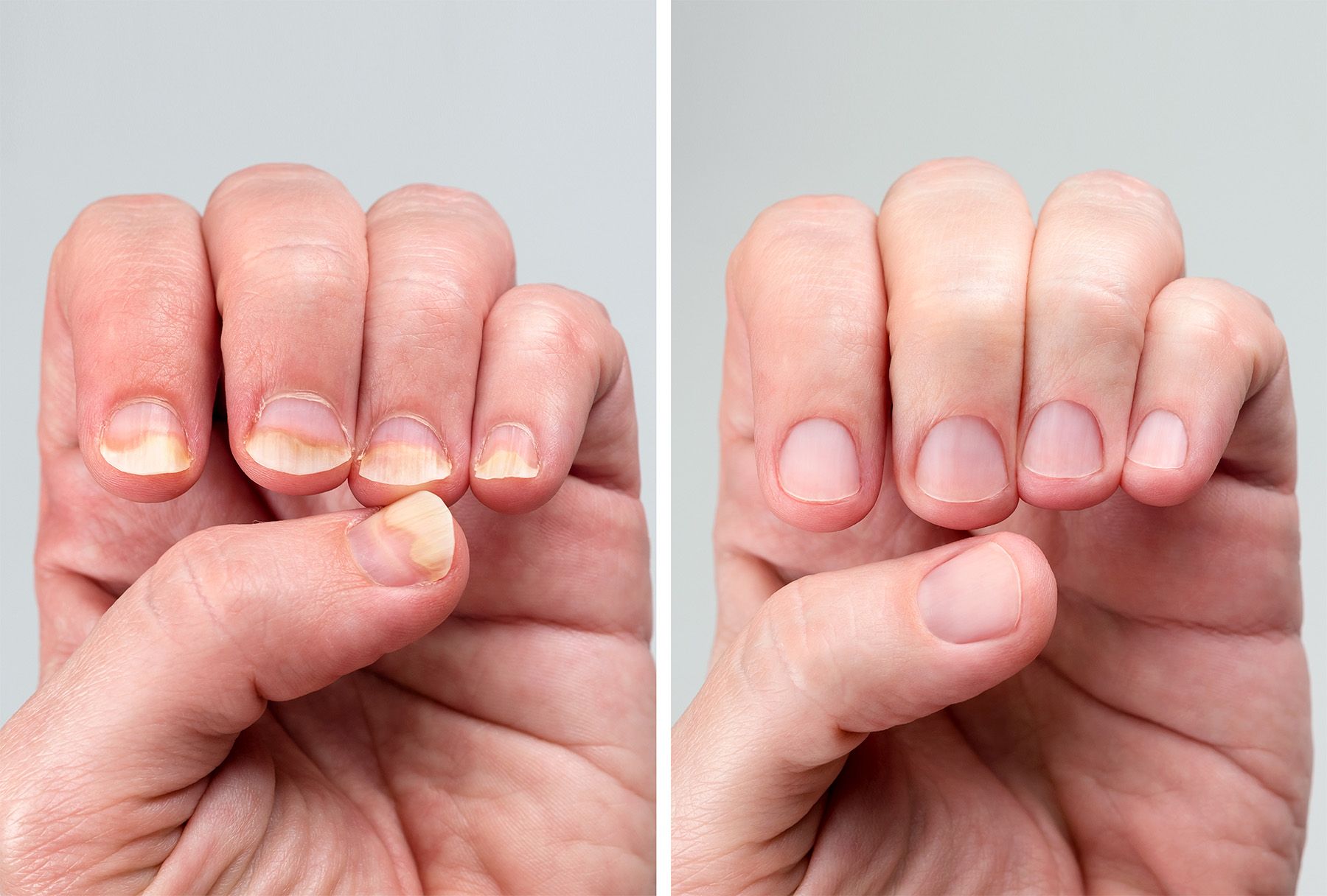 A before and after photo of a person's nails after fungus treatment