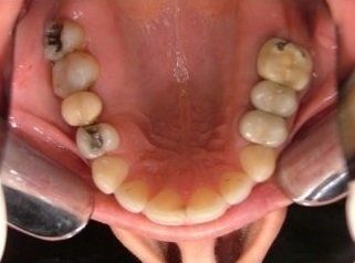 arcata dentale con carie