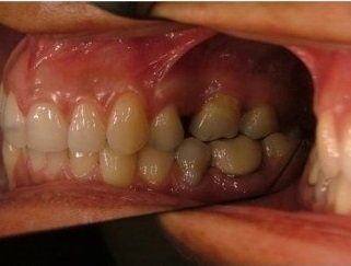 sovrapposizione arcate dentali