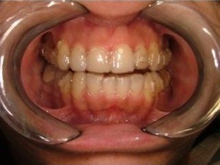 divaricatore cavo orale