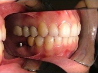 corretta occlusione dentale