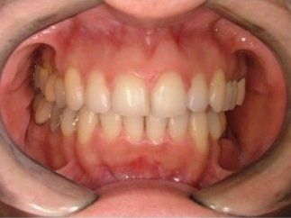 denti allineati