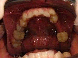 denti arcata superiore storti