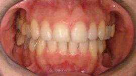 malocclusione dentale