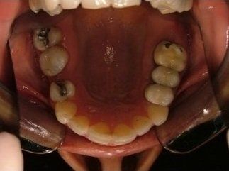 denti prima della terapia ortodontica