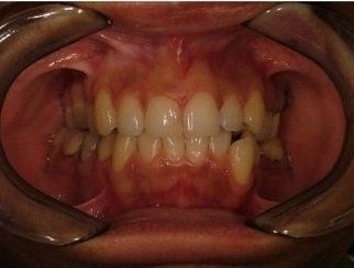 denti da raddrizzare