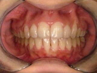 denti troppo stretti