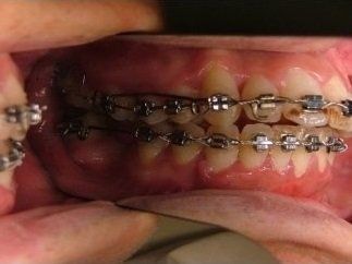 apparecchio fisso dentale