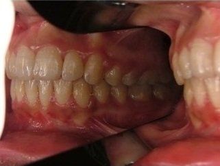 denti che digrignano