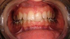 sovrapposizione disarmonica arcate dentali