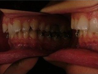 trattamento per riallineare i denti