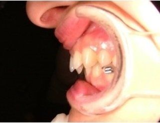 trattamento di ortodonzia linguale