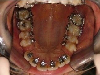 denti allineati con brackets interni