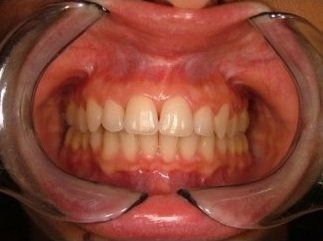 denti curati con ortodonzia linguale