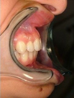 apribocca per inserimento brackets