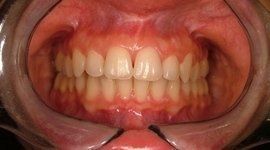 denti allineati con ortodonzia linguale