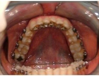 apparecchio con brackets