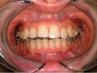 apribocca per intervento dentale