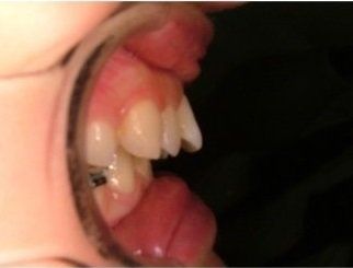 vista laterale sovrapposizione arcate dentali