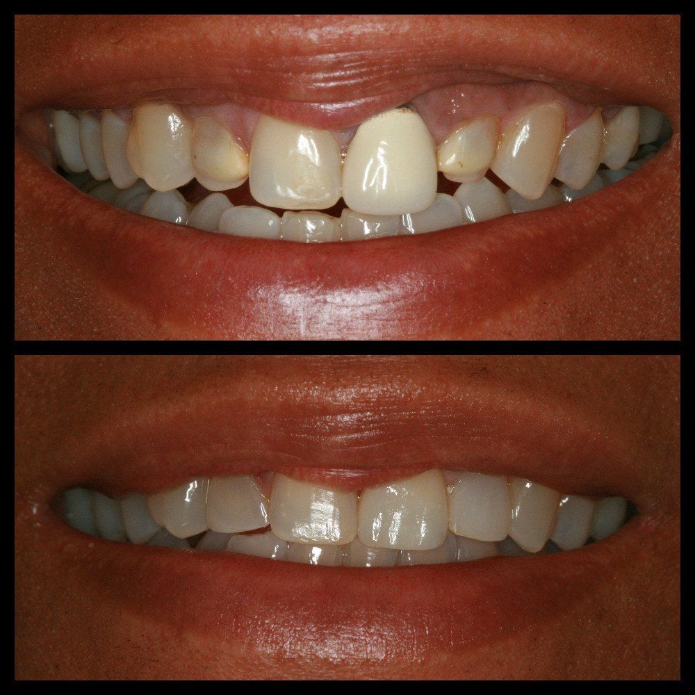One porcelain crown and two composite veneers