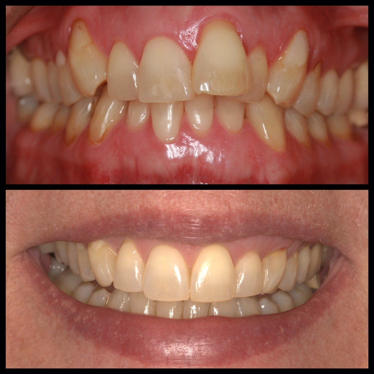 Cosmetic ortho invisible teeth straightening and gum contouring