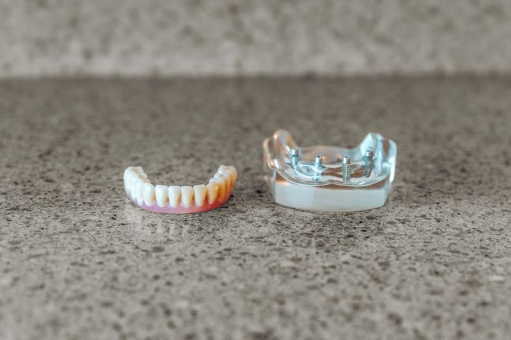 Dental Implants