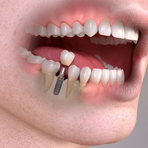 Dental Implants