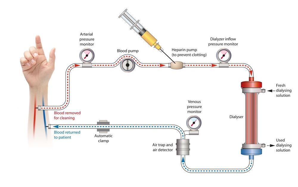 A diagram of a person 's arm with a syringe in it.
