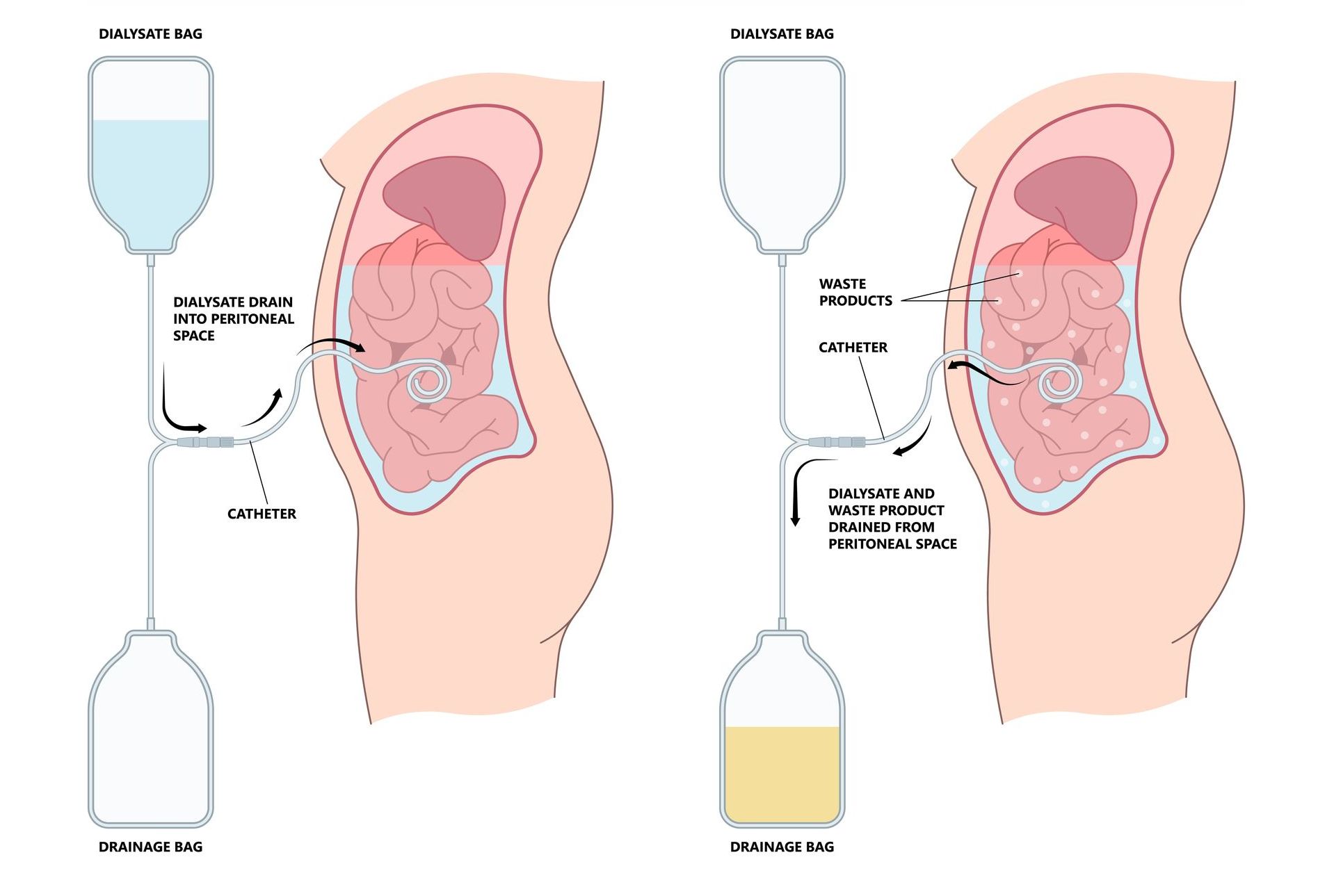 A diagram of a pregnant woman 's stomach with a hourglass and a bottle of liquid.