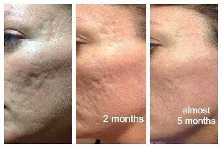 Progression of facial acne scars. Initial, 2-month, and almost 5-month images show scar reduction.