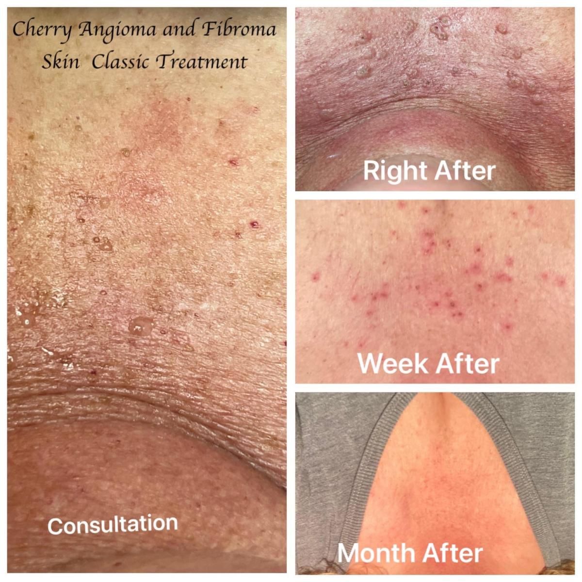 Skin treated for cherry angiomas and fibromas: before, right after, a week after, and a month after treatment.