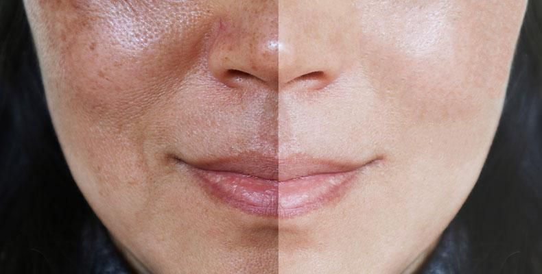 Half-face comparison: left side with dark spots, right side with smooth, even skin.
