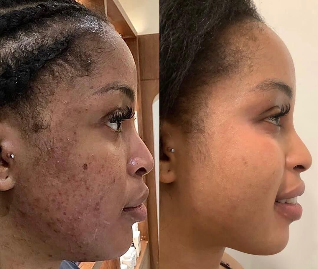 Before and after photos of a person with significant facial skin discoloration, and then with improved skin tone.