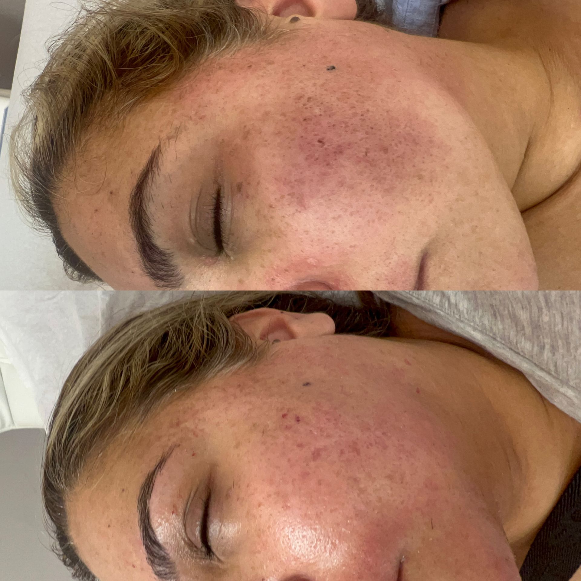 Before and after facial skin treatment: redness and freckles on cheek reduced.