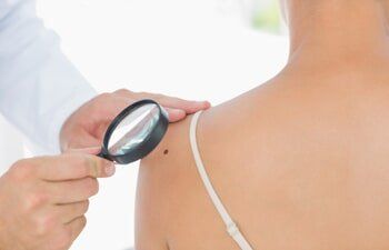 Skin Care Product — Mole Getting Check by a Dermatologist in Slidell, LA