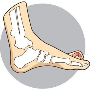 A sample photo of a claw toe