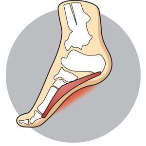 Plantar Fasciitis photo sample