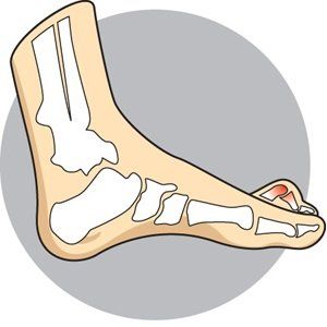 A sample photo of a hammer toe